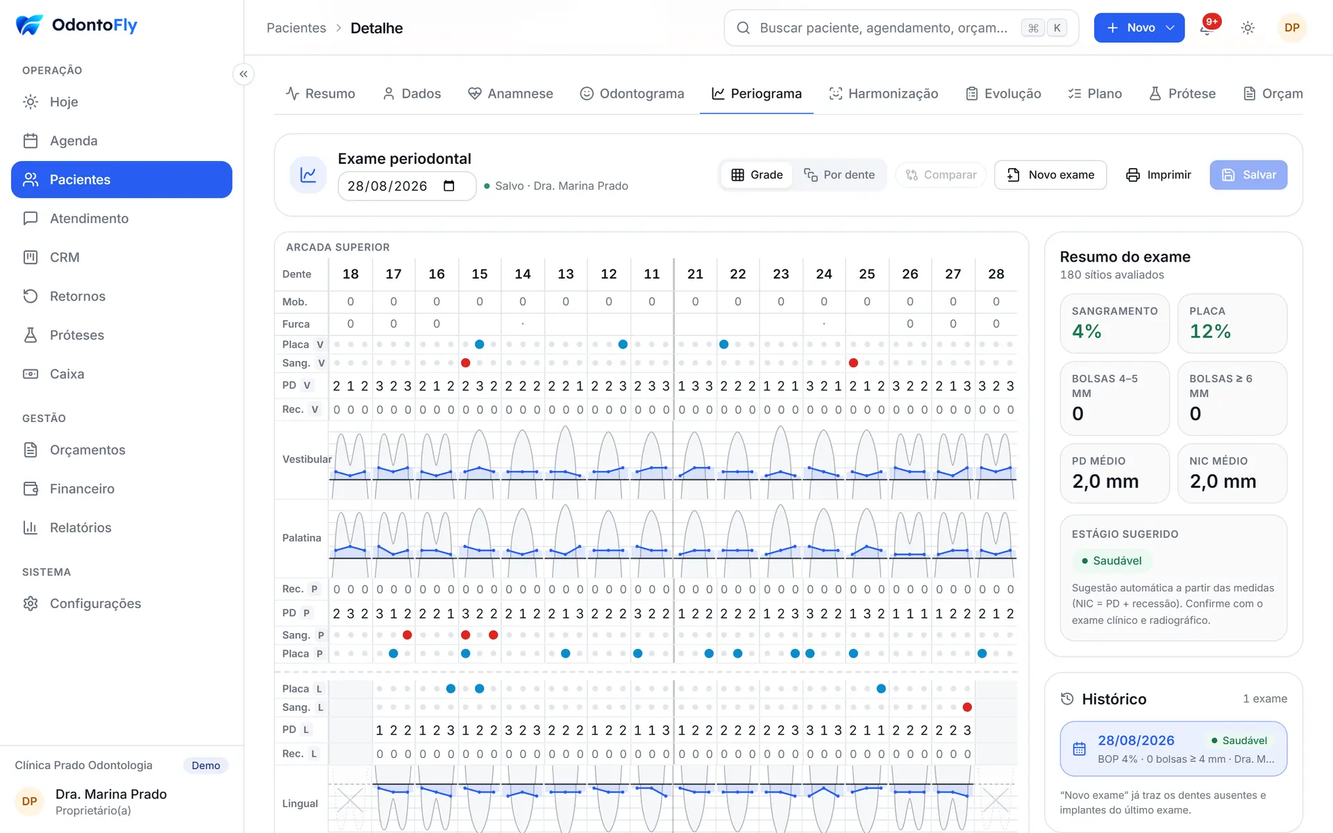 Periograma com profundidade de sondagem, recessão e sangramento por sítio